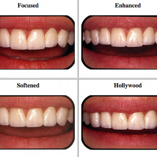 How To Choose The Best Veneers For Your Face Shape Dr Raanan